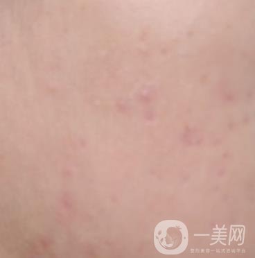 綿陽(yáng)中心醫(yī)院整形美容科祛痘坑怎么樣？?jī)r(jià)格表及術(shù)后*果分享
