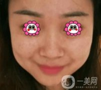 岳陽市第一人民醫(yī)院整形美容科祛斑好嗎？價(jià)格表和案例日記分享