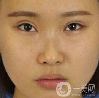 河北省中醫(yī)院整形美容科隆鼻怎么樣？價格表及術(shù)后恢復(fù)日記分享