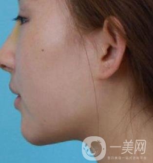 河北省中醫(yī)院整形美容科隆鼻怎么樣？價格表及術(shù)后恢復(fù)日記分享