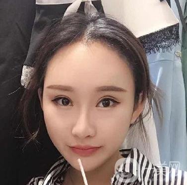河北省中醫(yī)院整形美容科隆鼻怎么樣？價格表及術(shù)后恢復(fù)日記分享