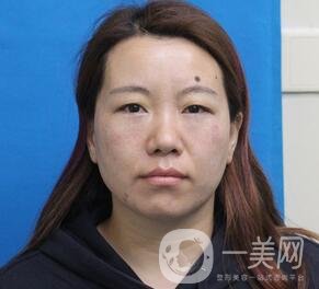 贛州市人民醫(yī)院整形科價(jià)格表，附祛眼袋案例分享