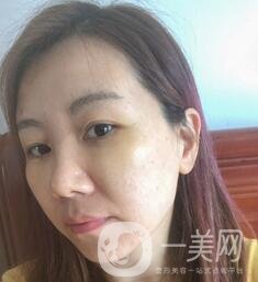贛州市人民醫(yī)院整形科價(jià)格表，附祛眼袋案例分享