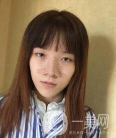 南昌二附院整形科價格表2020，附肋軟骨隆鼻整形案例