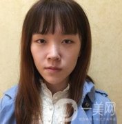 南昌二附院整形科價(jià)格表2020，附肋軟骨隆鼻整形案例