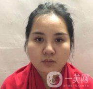 景德鎮(zhèn)第一人民醫(yī)院整形科價(jià)格表，附面部吸脂瘦臉案例