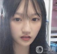 北京醫(yī)院趙紅藝做鼻子多少錢?價(jià)格表和真人果變化圖一覽