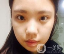 西安唐都醫(yī)院價(jià)格表價(jià)目表，內(nèi)附吳瓊隆鼻整形日記