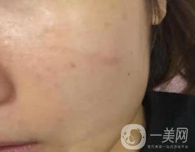 西安市中心醫(yī)院整形科價(jià)目?jī)r(jià)格一覽，附陶諫祛疤案例*果圖