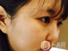 廣州博仕整形醫(yī)院做鼻子多少錢?價(jià)格表和整形恢復(fù)日記一覽