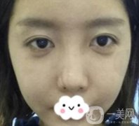 泉州二院整形外科可以打玻尿酸嗎？附價(jià)格表及玻尿酸隆鼻案例