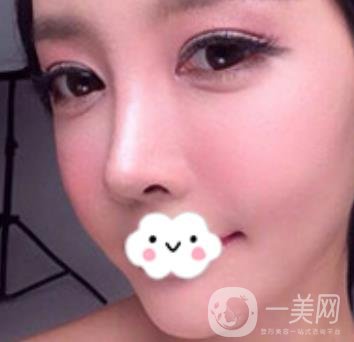 泉州二院整形外科可以打玻尿酸嗎？附價格表及玻尿酸隆鼻案例