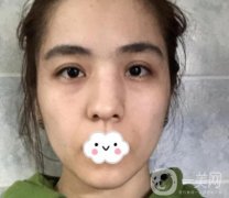上海伯思立整形怎么樣？附沈國雄隆鼻案例及整形價(jià)格表