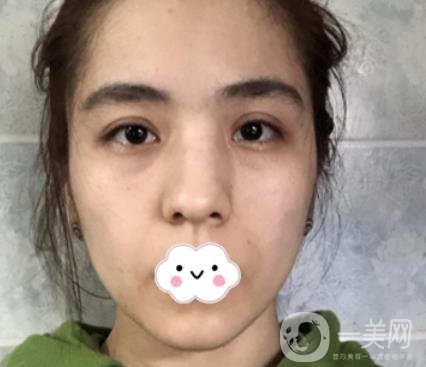 上海伯思立整形怎么樣？附沈國雄隆鼻案例及整形價格表