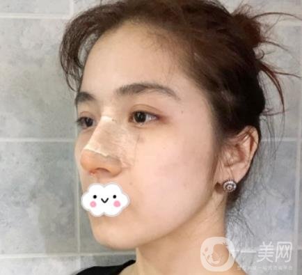 上海伯思立整形怎么樣？附沈國雄隆鼻案例及整形價格表