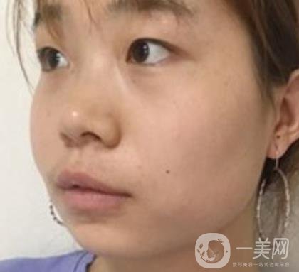 上海華美李志海磨骨多少錢(qián)？案例有嗎？整形價(jià)格表一覽