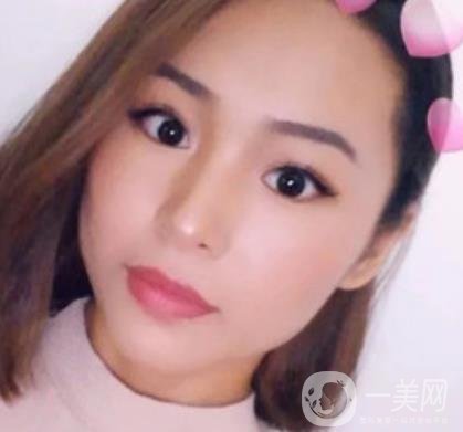 上海九院切下頜角手術(shù)經(jīng)歷分享，附2020整形價(jià)格一覽表