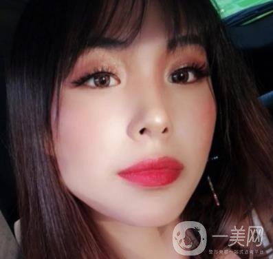 上海九院切下頜角手術(shù)經(jīng)歷分享，附2020整形價(jià)格一覽表