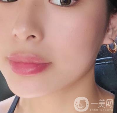 上海九院切下頜角手術(shù)經(jīng)歷分享，附2020整形價(jià)格一覽表