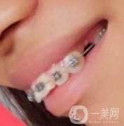 長征醫(yī)院整牙價(jià)格表，牙齒整形恢復(fù)果展示