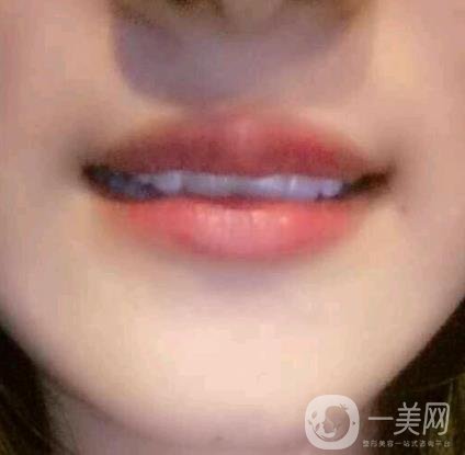 北京市海淀醫(yī)院整牙多少錢？看價格表及案例*果