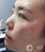 吉大一院整形美容科價格表費用明細(xì)，附祛斑案例