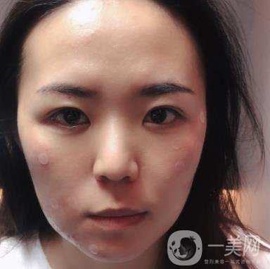 吉大一院整形美容科價(jià)格表費(fèi)用明細(xì)，附祛斑案例
