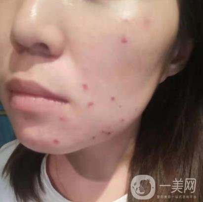 吉大一院整形美容科價(jià)格表費(fèi)用明細(xì)，附祛斑案例