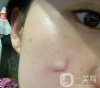 河北省中醫(yī)院整形美容科去疤果如何？價格表及案例實拍圖公布