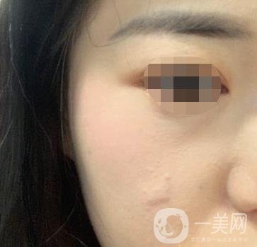 河北省中醫(yī)院整形美容科去疤*果如何？?jī)r(jià)格表及案例實(shí)拍圖公布