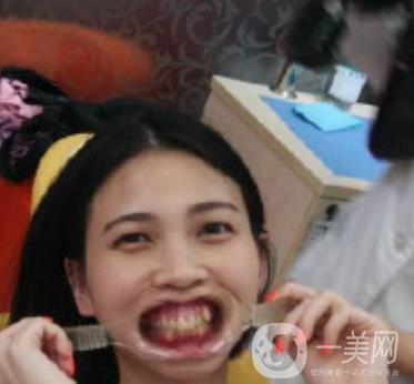 南昌大學(xué)第二附屬醫(yī)院整牙60天案例，還有價格表哦