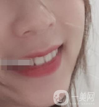 南昌大學(xué)第二附屬醫(yī)院整牙60天案例，還有價格表哦
