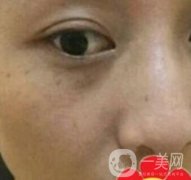 南方醫(yī)科大學(xué)南方醫(yī)院祛斑果咋樣_案例_價(jià)格表