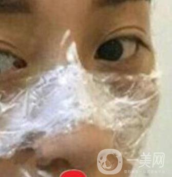 南方醫(yī)科大學南方醫(yī)院祛斑*果咋樣_案例_價格表