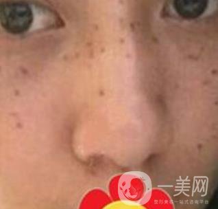 南方醫(yī)科大學南方醫(yī)院祛斑*果咋樣_案例_價格表