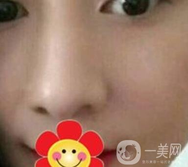 南方醫(yī)科大學南方醫(yī)院祛斑*果咋樣_案例_價格表