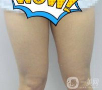 鹽城東方女子整形醫(yī)院價格表_抽脂瘦身案例