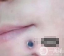 蘭州軍區(qū)陸軍總院皮膚科價格表_祛痣案例展示