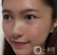 沈陽軍區(qū)總醫(yī)院整形外科價格表2020，附雙眼皮案例