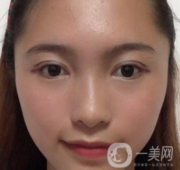 沈陽軍區(qū)總醫(yī)院整形外科價(jià)格表2020，附雙眼皮案例