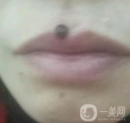 鹽城東方女子整形醫(yī)院價格表_點痣果一覽