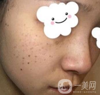 浙二醫(yī)院整形美容科價格表*新版，附激光祛斑*終*果圖