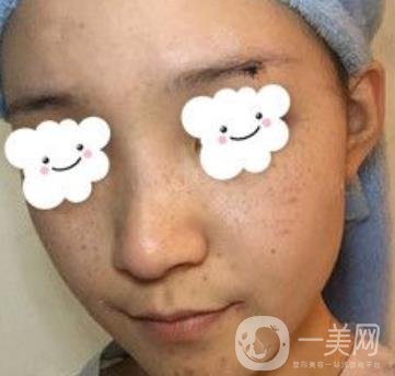 浙二醫(yī)院整形美容科價格表*新版，附激光祛斑*終*果圖