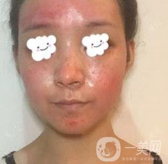 浙二醫(yī)院整形美容科價格表*新版，附激光祛斑*終*果圖