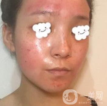 浙二醫(yī)院整形美容科價格表*新版，附激光祛斑*終*果圖