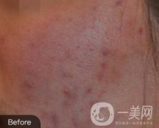 南通維多利亞美容醫(yī)院怎么樣?價格表收費項目和祛痘果實拍圖