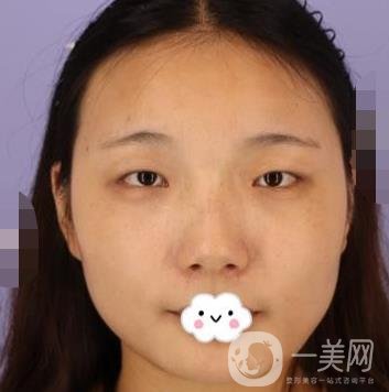 北京安貞醫(yī)院整容怎么樣？李斌斌修復(fù)雙眼皮怎么樣？內(nèi)含案例及價(jià)格表