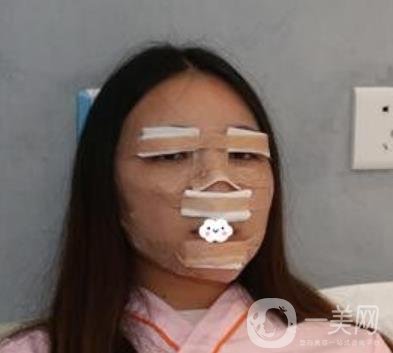 北京安貞醫(yī)院整容怎么樣？李斌斌修復(fù)雙眼皮怎么樣？內(nèi)含案例及價(jià)格表