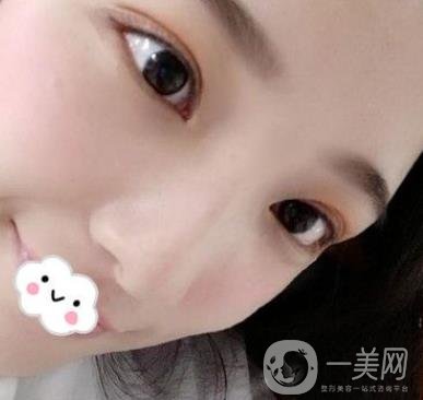 北京安貞醫(yī)院整容怎么樣？李斌斌修復(fù)雙眼皮怎么樣？內(nèi)含案例及價(jià)格表