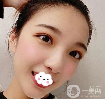 北京安貞醫(yī)院整容怎么樣？李斌斌修復(fù)雙眼皮怎么樣？內(nèi)含案例及價(jià)格表